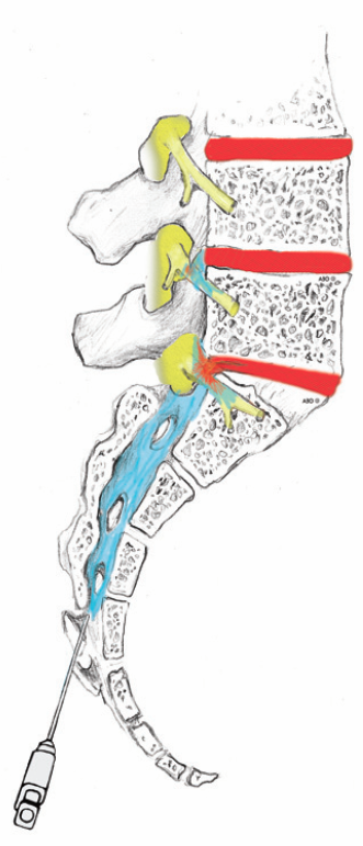 Caudal Epidural Steroid Injection – Initium